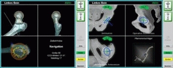 Computer Assisted Hip Surgery