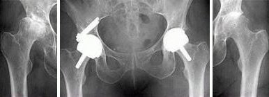 Arthritis due to Dysplasia of the Hip BHR - Resurfacing on both sides